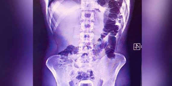 Urfa’da Hacamat Yaptıran Kişinin Anüs Bölgesine Çay Bardağı Kaçtı: Ameliyat ile Çıkarıldı