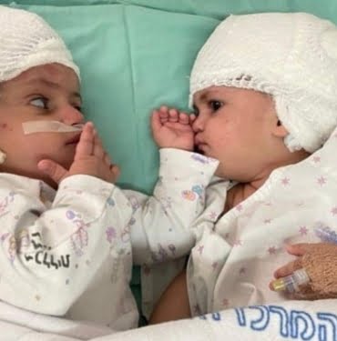 20210906-israilli-yapisik-ikizler-reuters