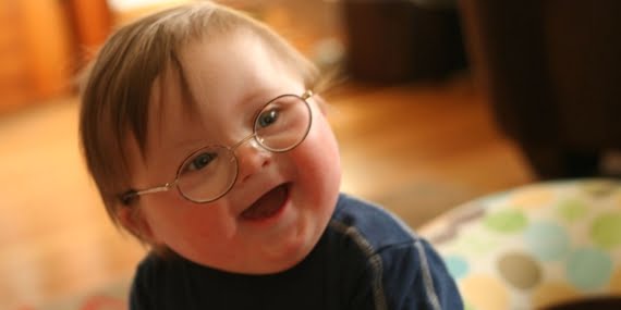 Bugün down sendromu farkındalık günü: Peki down sendromu nedir?