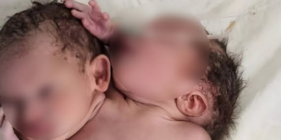 Hindistan’da iki başı üç eli olan bebek dünyaya geldi