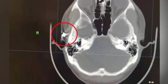 20 yıldır başı ağrıyan adamın kafasında mermi bulundu