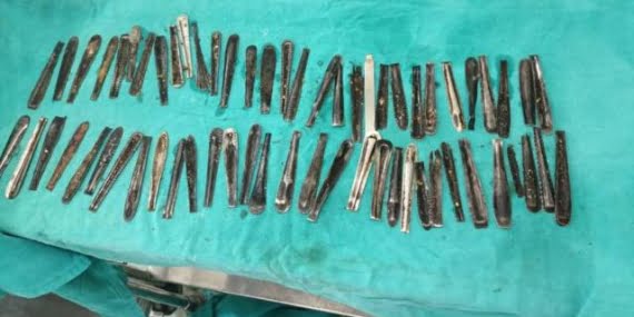 Bir yıldır kaşık yiyordu: Midesinden 60 kaşık çıktı