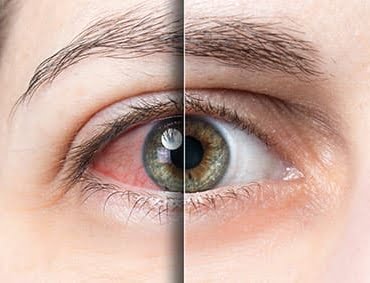 glokom_goz_tansiyonu_foto_kaanunlu