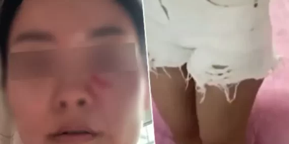 Kayınpeder ‘şort’ kavgasında gelinin üzerine sıcak çorba döktü