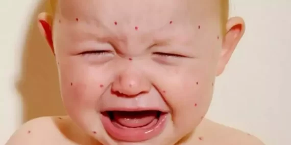 Kızamık kabusu geri döndü; İstanbul’da kızamık nedeniyle ölen çocuklar var