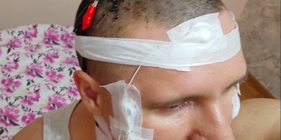 Beynini matkapla deldi