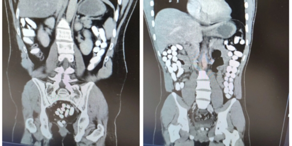 Mide ve bağırsaklarında uyuşturucu çıkan zanlılar tutuklandı