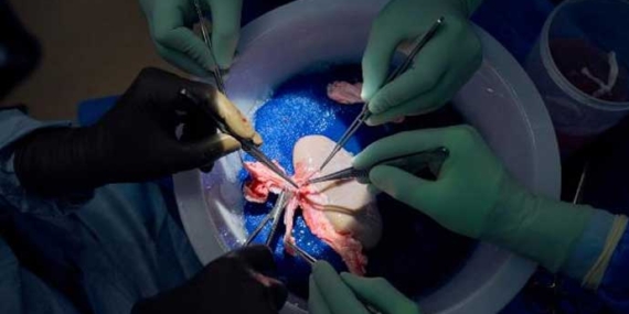 Tıp dünyasında bir ilk: İnsana nakledilen domuz böbreği vücuda uyum sağladı