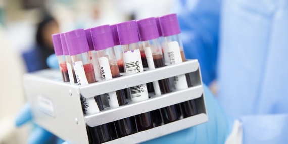 Covid-19’dan Alzheimer’a, hastalıkları 10 dakikada tespit edebilen kan testi geliştirildi