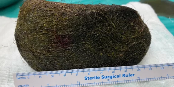 Mide ve bağırsağından 2 kilogram kıl çıktı