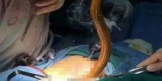 Bir hastanın bağırsaklarında 30 cm uzunluğunda yılan bulundu ve hala canlıydı Bir hastanın bağırsaklarında 30 cm uzunluğunda yılan bulundu ve hala canlıydı