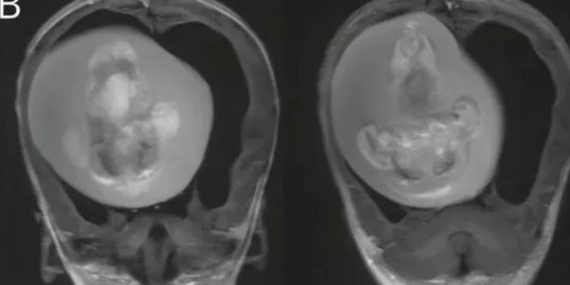 1 yaşındaki bebeğin beyninden ikizi çıkarıldı