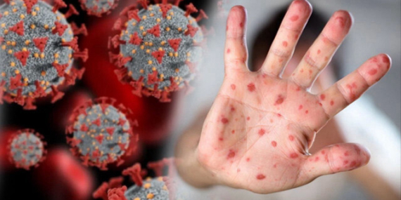 Korku büyüyor: M çiçeği salgını sadece Afrika’nın değil tüm dünyanın sorunu