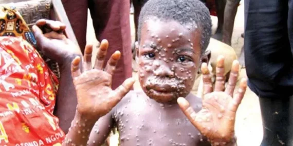 Maymun çiçeğinde son gelişme: Mevcut vakaların çoğu çocuk