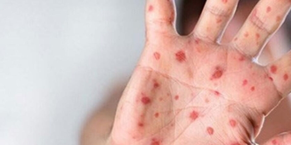 Maymun çiçeği virüsü İstanbul’da görüldü mü? İl Sağlık Müdürlüğü’nden açıklama geldi