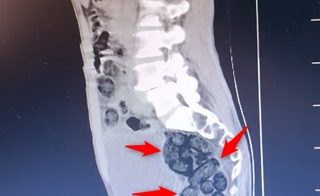 Batman’da uyuşturucu operasyonu: 472 gram metamfetamin ele geçirildi